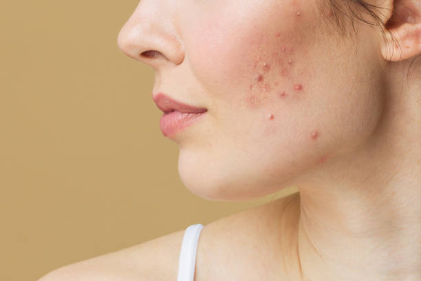 Best Acne Doctor in Ghaziabad