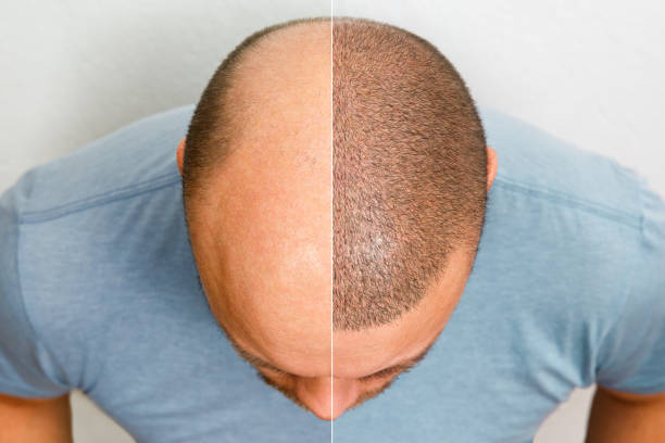 Best Hair Transplant Clinic in Delhi NCR